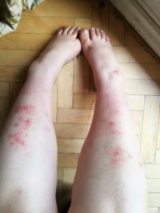 zdjęcie pokrytych czerwoną wysypką nóg Galantej Lali
